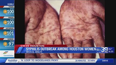 The Syphilis Outbreak